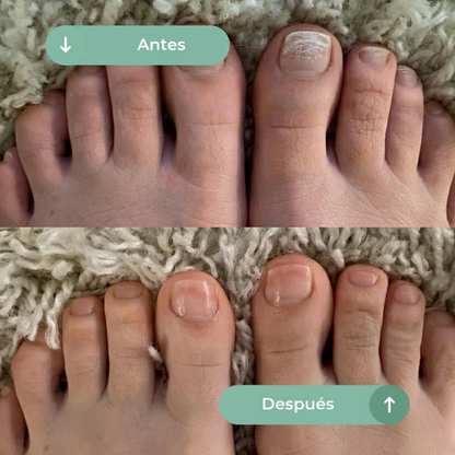 FUNGICLEAR : El aceite que elimina y previene el 99.9% del pie de atleta